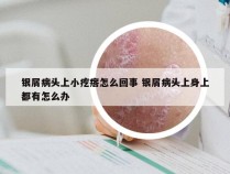 银屑病头上小疙瘩怎么回事 银屑病头上身上都有怎么办