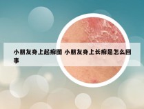 小朋友身上起癣图 小朋友身上长癣是怎么回事