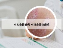 小儿会得癣吗 小孩会得体癣吗