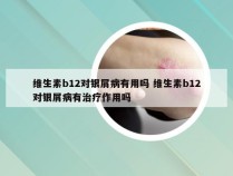 维生素b12对银屑病有用吗 维生素b12对银屑病有治疗作用吗