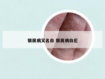 银屑病又名白 银屑病白庀