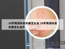 10岁男孩头皮长癣怎么治 10岁男孩头皮长癣怎么治疗