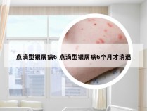 点滴型银屑病6 点滴型银屑病6个月才消退