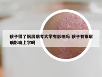 孩子得了银屑病考大学有影响吗 孩子有银屑病影响上学吗