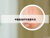 中医能治疗牛皮癣方法