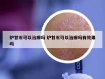 炉甘石可以治癣吗 炉甘石可以治癣吗有效果吗