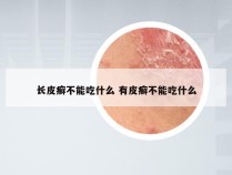 长皮癣不能吃什么 有皮癣不能吃什么