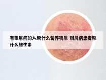 有银屑病的人缺什么营养物质 银屑病患者缺什么维生素