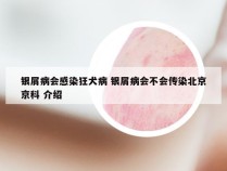 银屑病会感染狂犬病 银屑病会不会传染北京京科 介绍