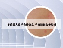 手癣跟人牵手会传染么 手癣接触会传染吗