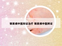 银屑病中医辩证治疗 银屑病中医辨证