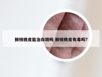 鲜核桃皮能治白斑吗 鲜核桃皮有毒吗?