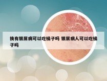 换有银屑病可以吃橘子吗 银屑病人可以吃橘子吗