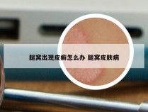 腿窝出现皮癣怎么办 腿窝皮肤病