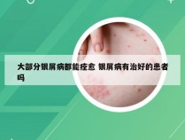 大部分银屑病都能痊愈 银屑病有治好的患者吗