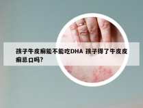 孩子牛皮癣能不能吃DHA 孩子得了牛皮皮癣忌口吗?