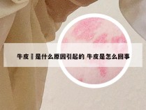 牛皮廯是什么原因引起的 牛皮是怎么回事