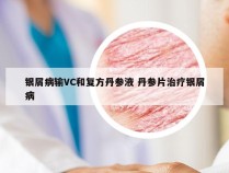 银屑病输VC和复方丹参液 丹参片治疗银屑病