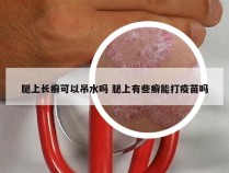 腿上长癣可以吊水吗 腿上有些癣能打疫苗吗