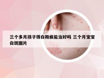 三个多月孩子得白殿疯能治好吗 三个月宝宝白斑图片