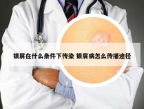 银屑在什么条件下传染 银屑病怎么传播途径