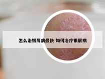 怎么治银屑病最快 如何冶疗银屑病