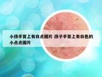 小孩手背上有白点图片 孩子手背上有白色的小点点图片