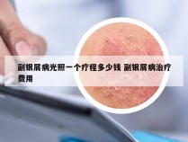 副银屑病光照一个疗程多少钱 副银屑病治疗费用