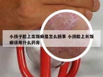 小孩子脸上出饭癣是怎么回事 小孩脸上长饭癣该用什么药膏