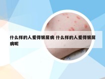 什么样的人爱得银屑病 什么样的人爱得银屑病呢