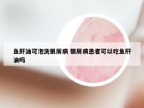 鱼肝油可泡洗银屑病 银屑病患者可以吃鱼肝油吗