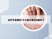 治疗牛皮癣的3个小偏方用过的都好了