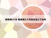 银屑病1个月 银屑病几个月后会自己下去吗