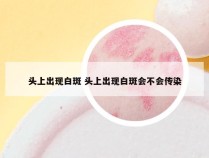 头上出现白斑 头上出现白斑会不会传染