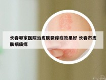 长春哪家医院治皮肤骚痒症效果好 长春市皮肤病瘙痒