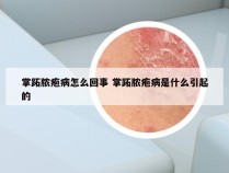 掌跖脓疱病怎么回事 掌跖脓疱病是什么引起的