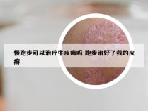 慢跑步可以治疗牛皮癣吗 跑步治好了我的皮癣