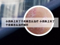 小孩身上长了个皮癣怎么治疗 小孩身上长了个皮癣怎么治疗图片