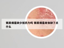 银屑病是缺少抵抗力吗 银屑病是身体缺了点什么