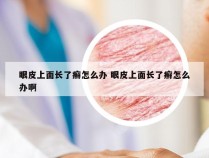 眼皮上面长了癣怎么办 眼皮上面长了癣怎么办啊