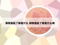 脚侧面起了癣是什么 脚侧面起了癣是什么病