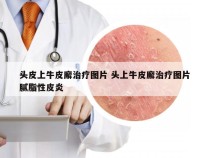 头皮上牛皮廨治疗图片 头上牛皮廨治疗图片腻脂性皮炎