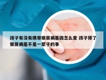 孩子有没有携带银屑病基因怎么查 孩子得了银屑病是不是一辈子的事