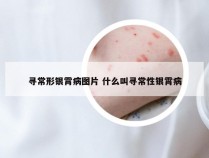 寻常形银霄病图片 什么叫寻常性银霄病