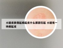 小腿皮肤像起癣起皮什么原因引起 小腿有一块癣起皮