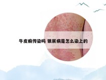 牛皮癣传染吗 银屑病是怎么染上的