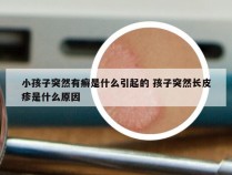 小孩子突然有癣是什么引起的 孩子突然长皮疹是什么原因