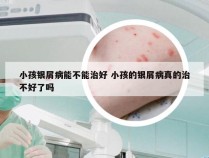 小孩银屑病能不能治好 小孩的银屑病真的治不好了吗