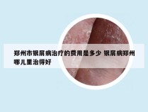 郑州市银屑病治疗的费用是多少 银屑病郑州哪儿里治得好