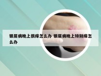 银屑病晚上很痒怎么办 银屑病晚上特别痒怎么办